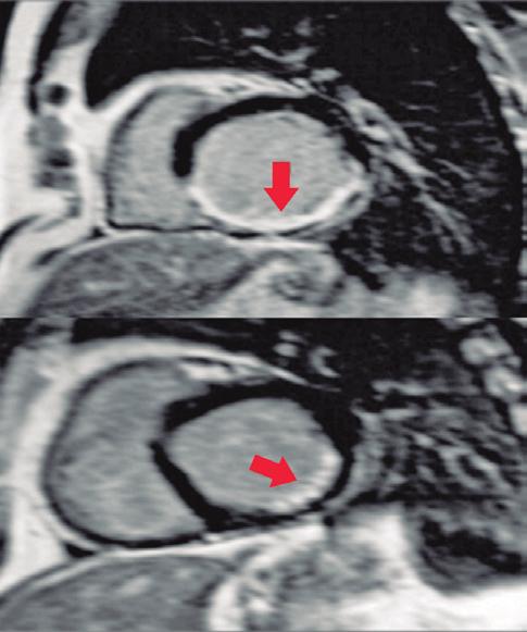 Figura 6: Realce tardio pelo gadolíneo por imagens de ressonância magnética cardiovascular, demonstrando densidade de cicatriz póstero-lateral no ventrículo esquerdo.