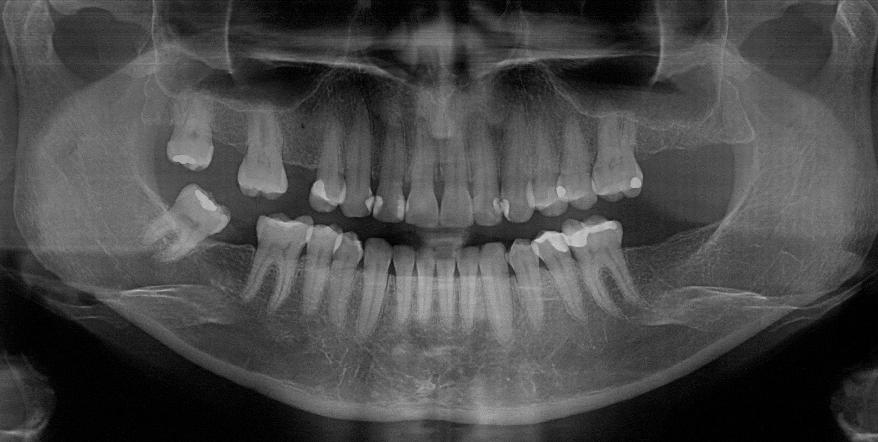 CASO CLÍNICO Paciente A.S., gênero feminino, apresenta má oclusão de classe I, ausência do segundo pré-molar superior direito, 2 molar superior direito e 2 molar inferior direito, diastemas superior