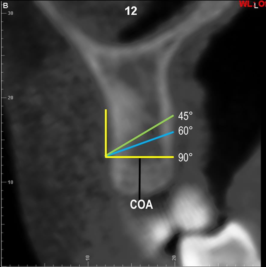 25 Figura 3 - Reconstrução ortogonal para avaliação da largura óssea alveolar em diferentes ângulos. O inicio das medidas utilizou a COA como referência.