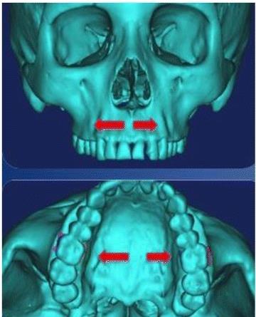 Fonte: MACGINNIS,2014 Em 2014, foi realizado um estudo in vitro para analisar a distribuição de tensão de deslocamento de estruturas craniofaciais resultantes da ERM de origem óssea com e sem