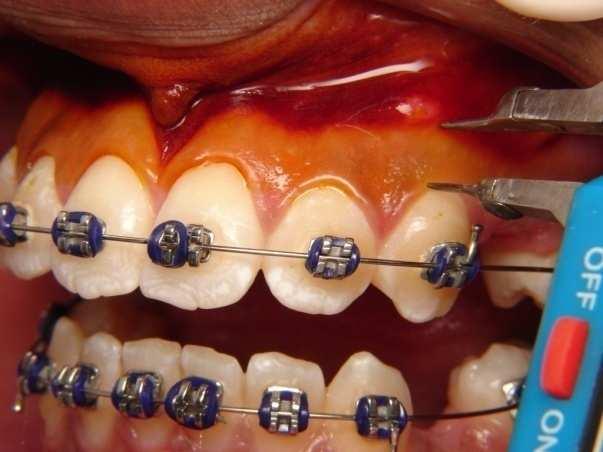 27 Medidas Periodontais As medidas periodontais foram realizadas pelo mesmo examinador em dois momentos (T 0 antes do início da retração e T 1 ao término da retração).