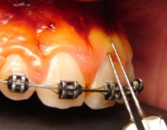 De posse do paquímetro digital periodontal realizou-se a medição, no centro da coroa clínica do dente em questão, da margem gengival livre até o limite entre mucosa ceratinizada e