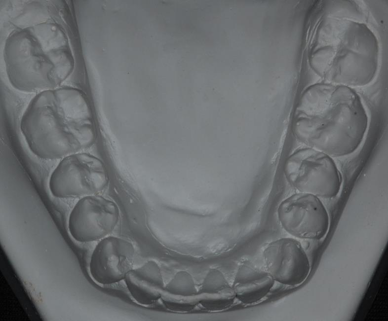 de 33,59 ), incisivos superiores e inferiores vestibularizados e protruídos (11.NA = 28,88 ; 11-NA = 10,61mm; 41.