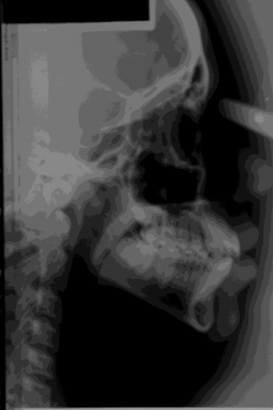 Portanto, o diagnóstico foi de má oclusão de Classe I de Angle, mordida aberta anterior dentária, maxila atrésica e interposição lingual. Figura 12: Fotografia intrabucal frontal.