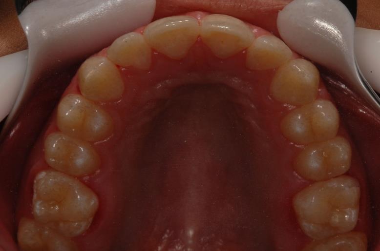 Figura 17: Fotografia intrabucal oclusal superior após a remoção do aparelho ortodôntico. Observa-se alinhamento adequado do arco superior. Figura 15: Fotografia intrabucal frontal com abertura bucal.