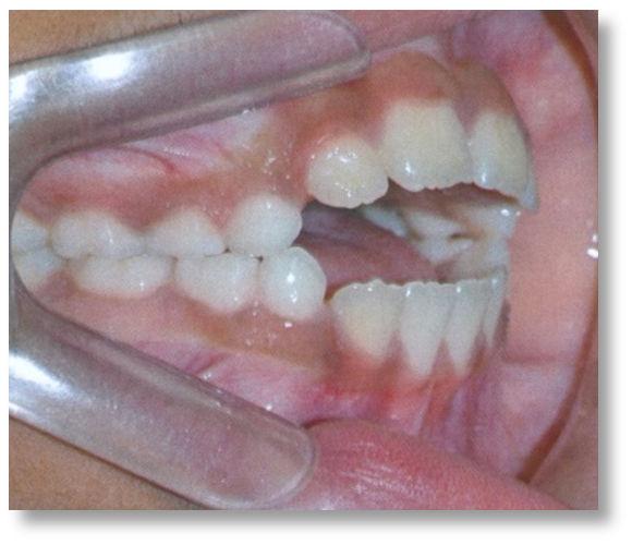 Na análise dentária observou-se uma relação molar classe I, com mordida aberta anterior dentaria de 3mm, maxila atrésica, sem