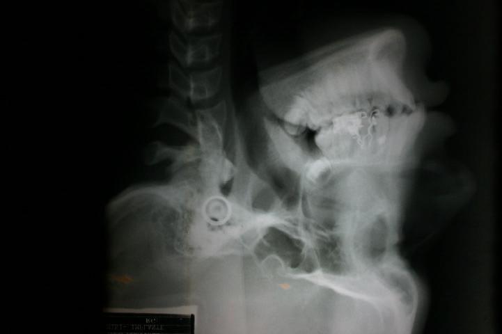 40 Uma telerradiografia em norma lateral foi então realizada com o paciente utilizando este guia para a certificação da correta posição de instalação dos miniimplantes (Figura 4.10).