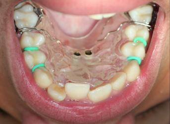 12 Cursor de borracha O método livre de incisão, escolhido e realizado neste experimento por um único cirurgião (RADS), justificou-se pela qualidade da gengiva do palato, e permitiu que uma broca