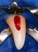 Dentes fraturados, com exposição pulpar ou sem condições de isolamento