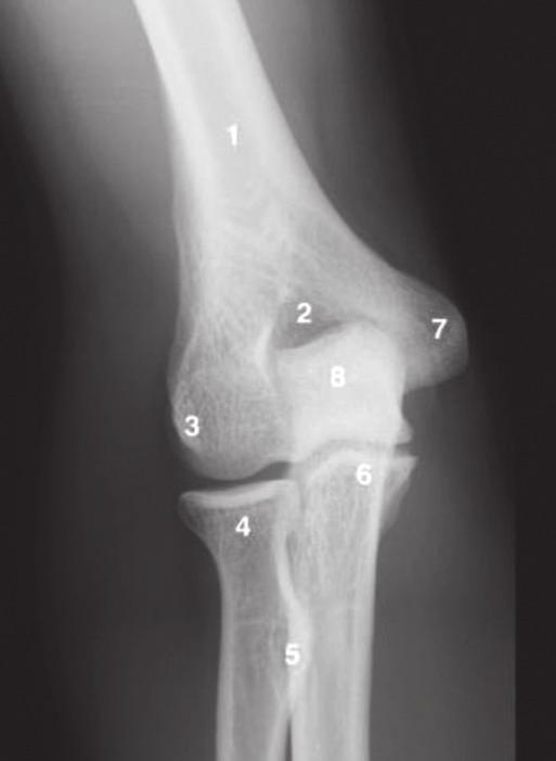 ATLAS DE RADIOLOGIA Radiografia em AP do cotovelo direito: (1) diáfise distal do úmero; (2) fossa do olécrano e fossa coronoide