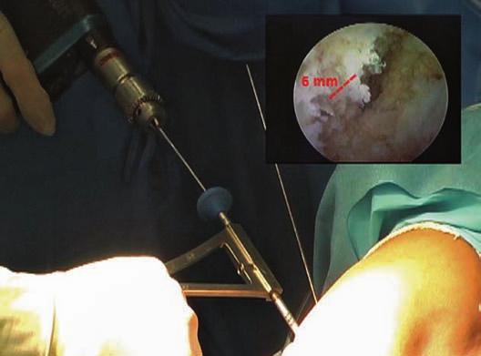 tibial PL e exteriorizado na região lateral do joelho através do túnel femoral PL.