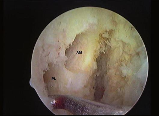 no túnel femoral posterolateral com o joelho em extensão de 15º (Figuras 7 e 8).
