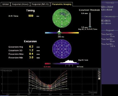 3) Fração de ejeção do ventrículo esquerdo (método de Simpson). II - Ecocardiografia Tridimensional: 1) Volume diastólico final do ventrículo esquerdo (VDFVE).