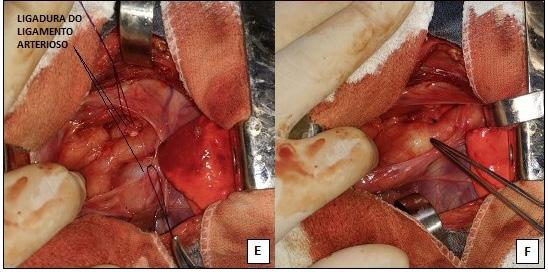 46 Figura 2. Imagens transoperatórias de procedimento cirúrgico para correção de persistência de arco aórtico direito em cão.