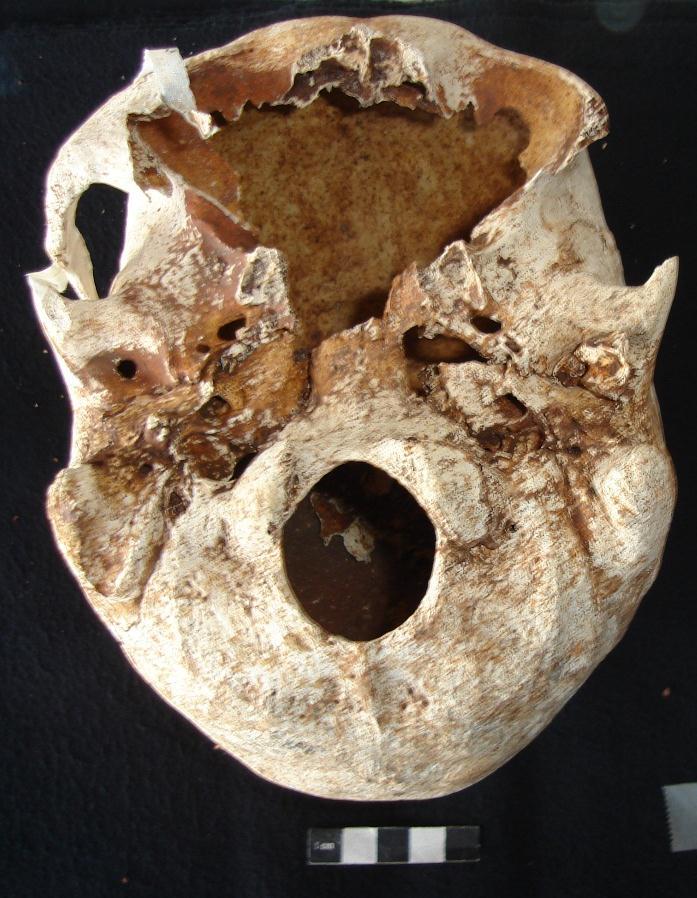 Como o crânio foi recuperado quase intacto e sem estar muito danificado, foi possível Figura 50- Vista frontal e inferior do Crânio do indivíduo da sepultura 6 (foto do autor) efectuar a diagnose