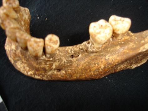 Tabela 52- Odontograma do indivíduo da sepultura 6 (Primeira linha marca a presença ou ausência do dente: O- ausente, X- presente.