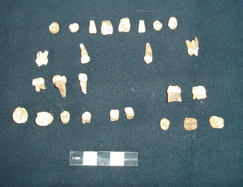 Figura 6- Dentição da Criança Maior da sepultura 2 (foto do autor) Como para os não-adultos apenas se efectua a estimativa da idade à morte, nestes indivíduos foi aplicado o método de Ubelaker (1979)