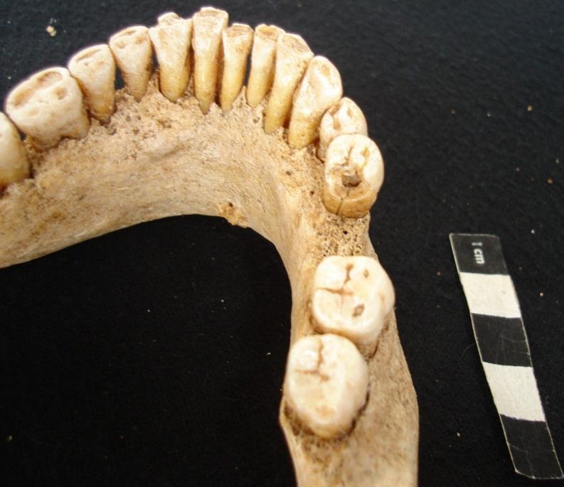 Também ocorreu perda ante-mortem do primeiro molar superior direito e do primeiro molar inferior direito (figura 13).