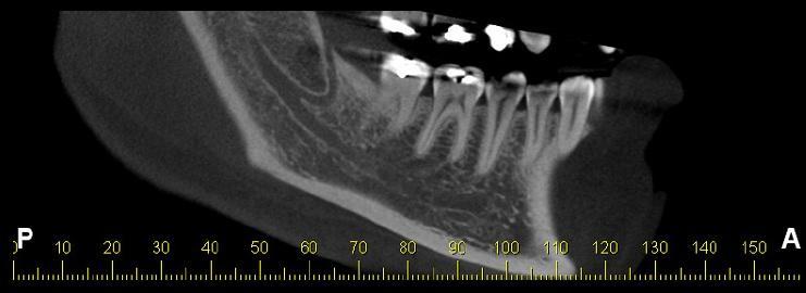 23 Figura 1 - Reconstrução panorâmica de Tomografia Computadorizada de Feixe Cônico de canal retromandibular tipo A1.