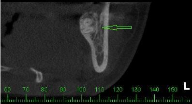 25 Figura 2 Secção coronal identificando ramificação retromolar do canal mandibular 3.