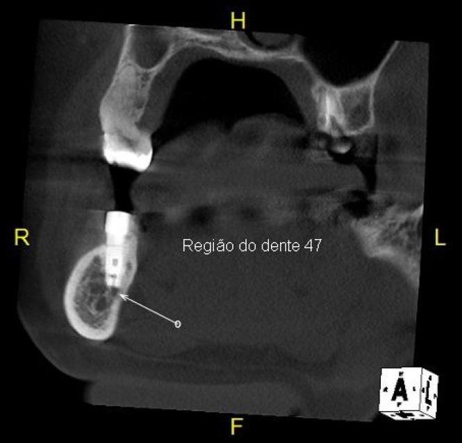 29 Figura 4 - Secção coronal de Tomografia Computadorizada de Feixe Cônico mostrando posicionamento de implante sob canal mandibular bifurcado.