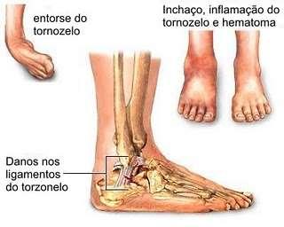 Entorse LUXAÇÃO E SUBLUXAÇÃO Luxação: há perda da aposição entre as superfícies articulares, podendo ser causada por: Traumatismo sobre