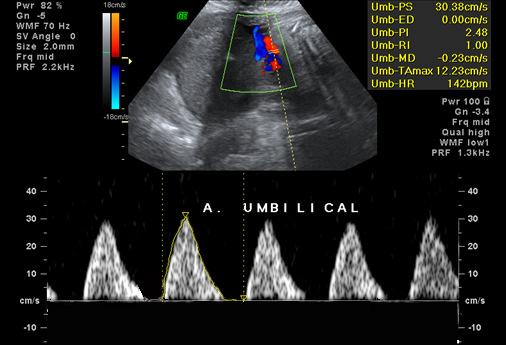 Neste estudo, foram avaliados os seguintes vasos: a) artérias umbilicais; b) artéria cerebral média; c) ducto venoso; d) artérias renais direita e esquerda.