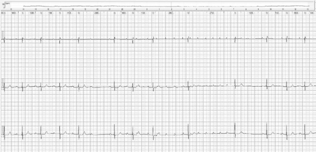 Julgue os itens a seguir, que apresentam traçados de estudo eletrofisiológico e de Holter.