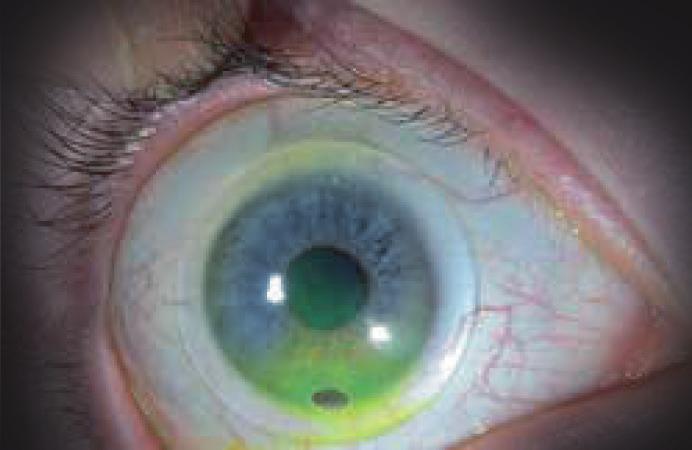 PERIFERIA TÓRICA (TP) Em alguns olhos adaptados com lentes esclerais onde tem-se áreas de pressão localizada as 3 e 9 horas e um aplanamento as 6 e 12 horas, faz-se necessário o uso