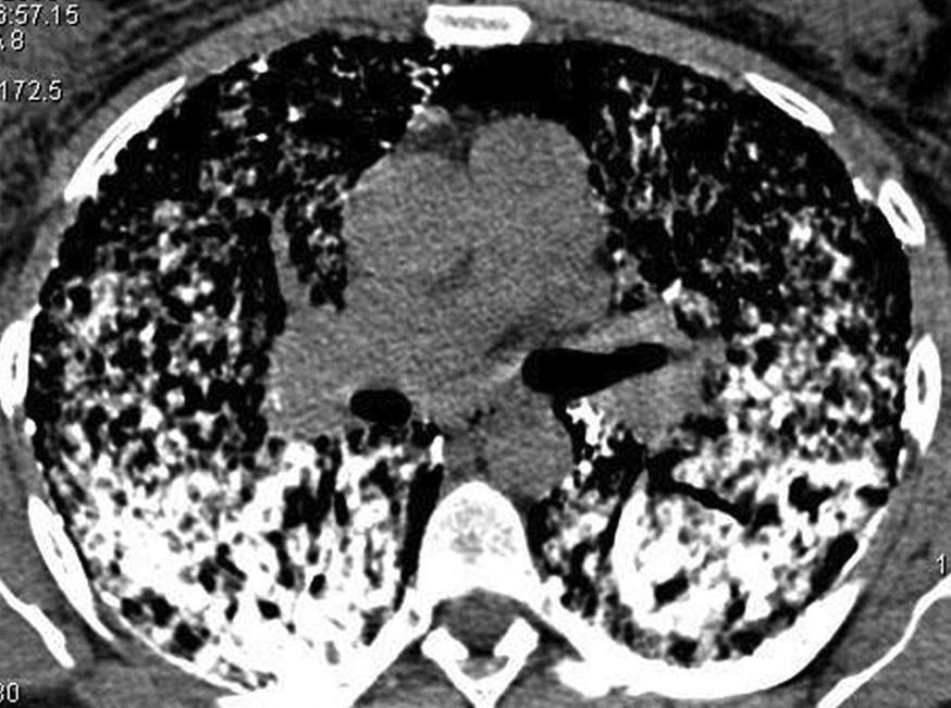 Microlitíase alveolar pulmonar: achados na tomografia computadorizada de alta resolução do tórax em 10 pacientes 555 Figura 3 - Corte com janela para mediastino, onde se observa confluência de