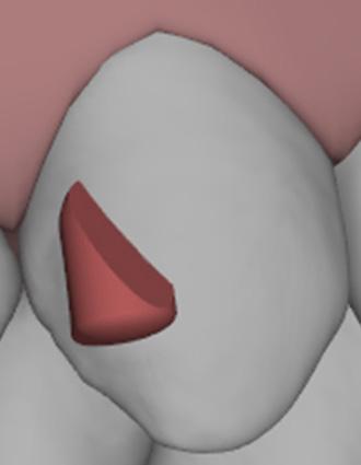 recomendados Você pode checar a quantidade de distalização na Ficha de Avaliação do Movimento Dentário na aba Tratamento Em que fase, durante o tratamento, recomendamos colocar os elásticos?