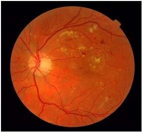 A base MESSIDOR [24] (Methods to evaluate segmentation and indexing techniques in the field of retinal opthamology) foi criada com o objetivo de facilitar estudos para diagnóstico de retinopatia