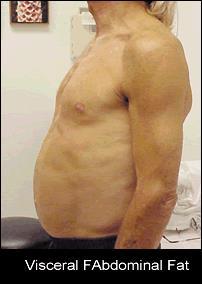 Deslocamento da gordura subcutânea para a visceral, em especial a abdominal.