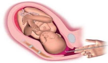 ausculta BCF) Transparente - prematuridade Opalescente - pós-data