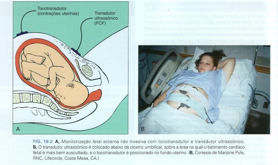 CONTRATILIDADE UTERINA X AUSCULTA BCF Efeitos das contrações sobre o feto: compressão do pólo cefálico sobre as estruturas pélvicas podendo levar à bossa, hemorragias intracranianas e estímulo vagal