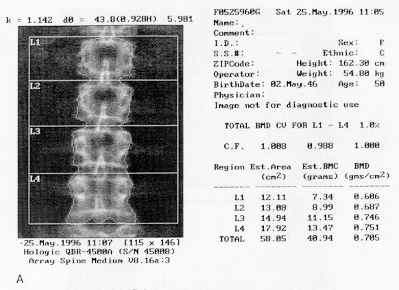 CAPÍTULO 3 Figura 3.6: Resultado da medição da DMO das vértebras lombares (L1 a L4) de uma mulher de 50 anos de idade [87].