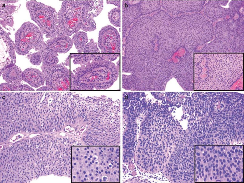 Introdução 12 Figura 2 Grau histológico das neoplasia uroteliais papilíferas. (a) Papiloma; (b) NUBPM; (c) Carcinoma papilífero de baixo grau; (d) Carcinoma papilífero de alto grau. (Miyamoto et al.