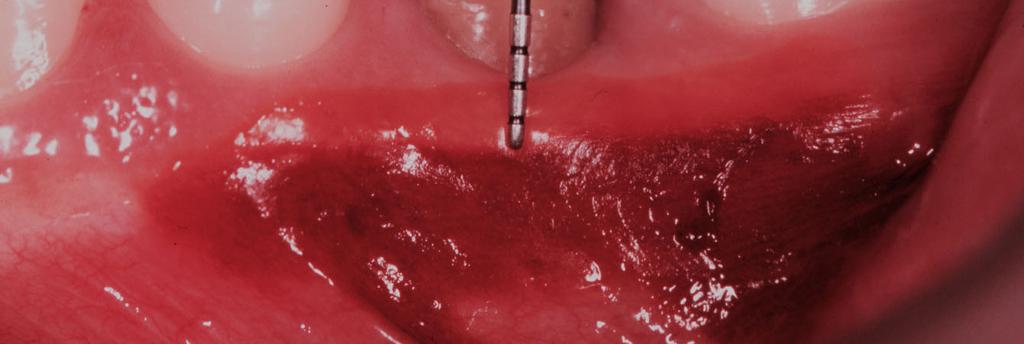 pré-molar a ser tratado, centro das faces