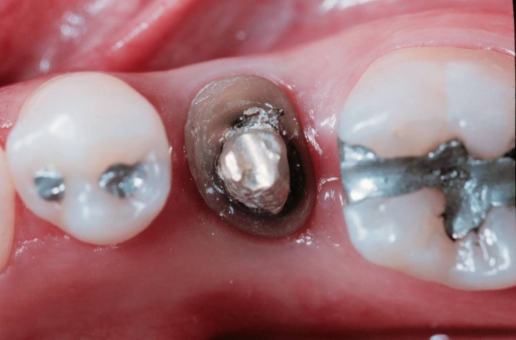 dente localizado à mesial (Da) e outro, no