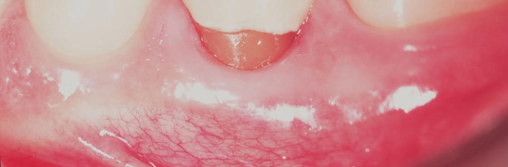 vestibular do segundo pré-molar ( ) com agulha