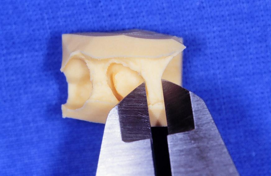 pré-molar e dente adjacente com paquímetro digital