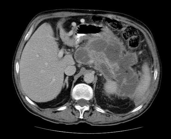 TC-abdominal indefiniçao dos contornos do