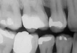 etária de 14 a 50 anos, provenientes da Clínica de Dentística da UFSC, os quais apresentavam, após exame clínico e radiográfico interproximal, lesões cariosas nas faces proximais de dentes
