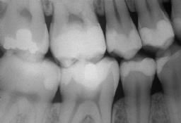 Uma vez comprovada a presença de cáries nas faces mesial e/ou distal, os pacientes foram informados sobre a natureza e o objetivo da pesquisa, bem como da necessidade de retornos periódicos para