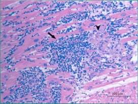 Critérios de Dallas (1986) categorização histopatológica para estabeler o Dg de miocardite (infiltrado inflamatório com necrose miocitária associada de isquémia) Infiltrados linfocíticos e