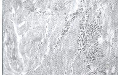 5%. Miocardiopatia,Taquiarritmias, síncope, MS).