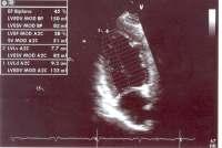 AL e apical, FS diminuida Coronárias normais BEM 15ºdia Fibrose intersticial / infiltrado