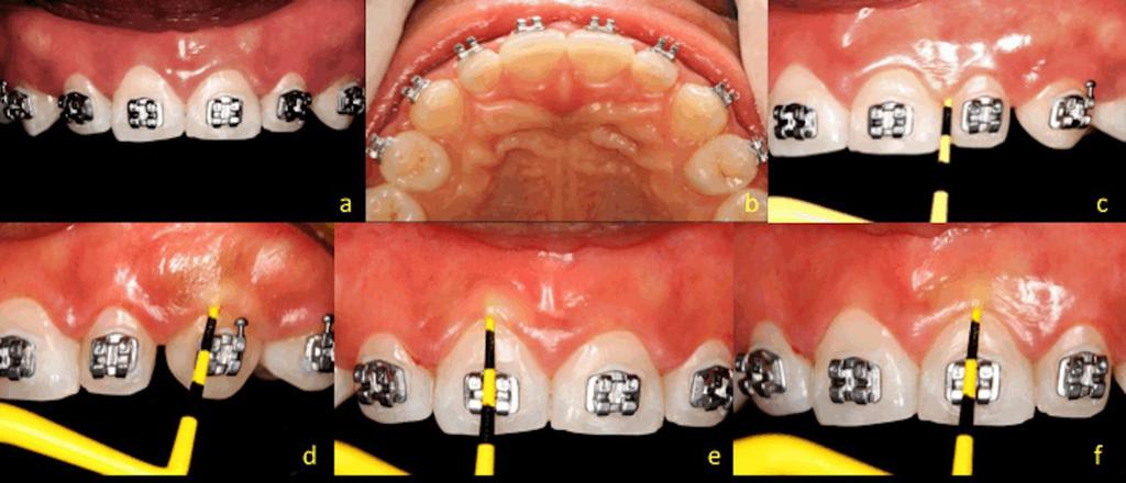 através das diversas técnicas cirúrgicas periodontais (Pires et al., 2010; Maia et al., 2011; Braga et al., 2015; Brito et al., 2016; Cardia et al., 2016).