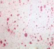 Sangue periférico com a presença de blastos indicados pela seta. Fonte : http:://www.leukemia-images.com/bilder.leukemiaimages.com/acute.myeloid.
