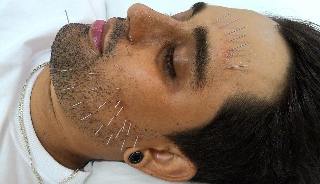 Acupuntura com base nas ramificações do nervo facial 3 Figura 1: Técnica de acupuntura que consiste na aplicação de agulhas no trajeto das ramificações do nervo facial.